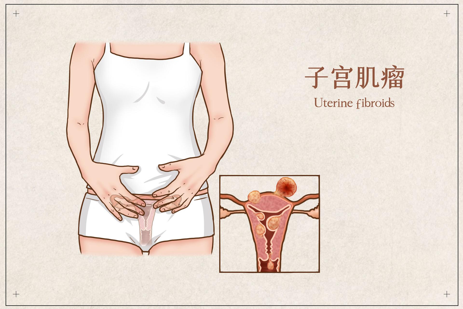 肌瘤最新进展研究及治疗策略